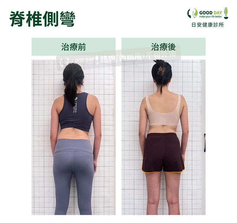 脊椎側彎（女性）療程前後的背部姿勢比較