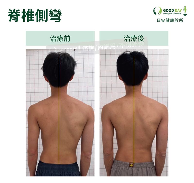 脊椎側彎（男性）療程前後的背部姿勢比較