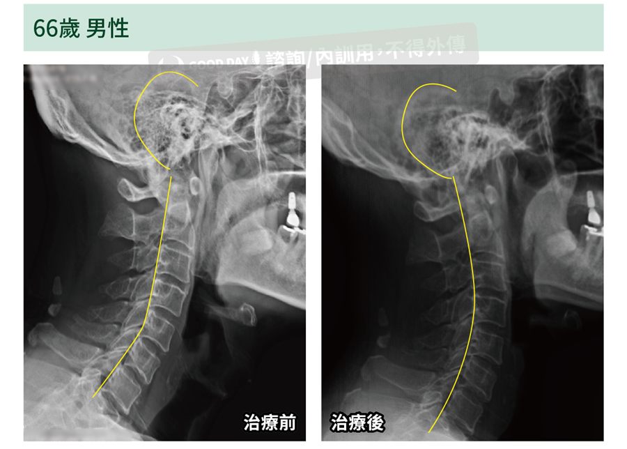 頸椎側面 X 光，療程前後比較：頸椎弧度變化